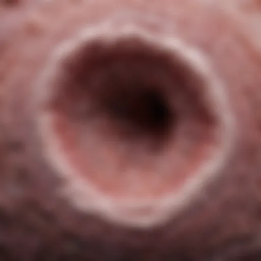 Microscopic view of malignant neoplasm in bladder wall