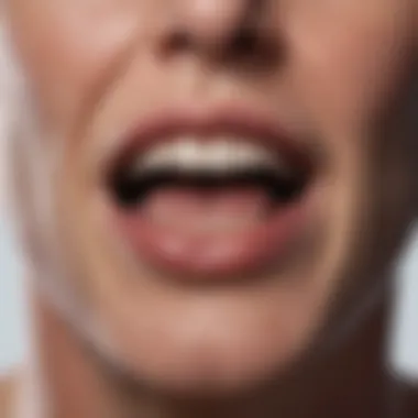 Mouth Sores in Multiple Myeloma Patients Illustration of mouth sores associated with multiple myeloma