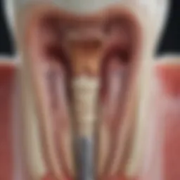 Diagram illustrating the anatomy of a tooth affected by root canal infection
